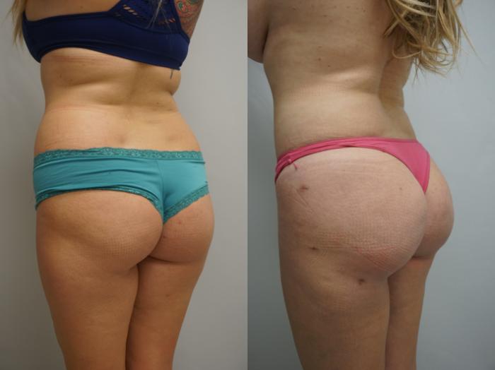 Before & After Liposuction Case 204 View #2 View in Gilbert, AZ