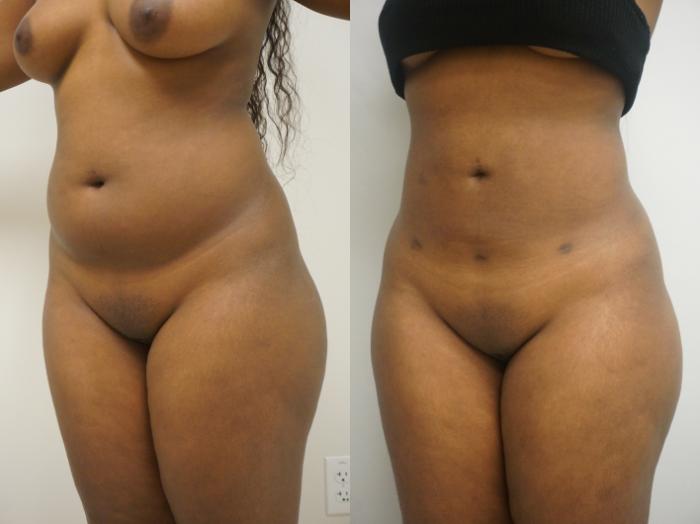 Before & After Liposuction Case 228 View #1 View in Gilbert, AZ