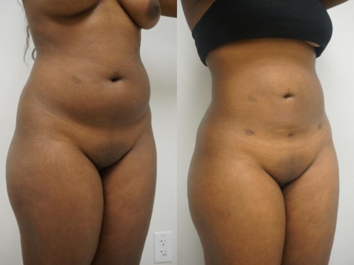 Before & After Liposuction Case 228 View #2 View in Gilbert, AZ