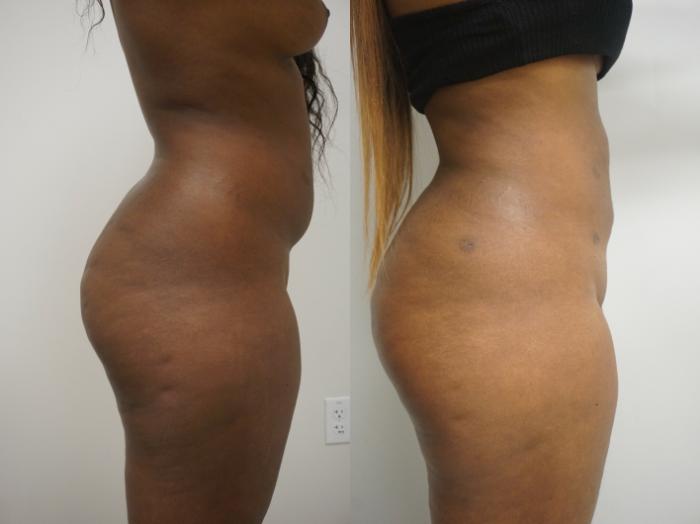 Before & After Liposuction Case 228 View #3 View in Gilbert, AZ