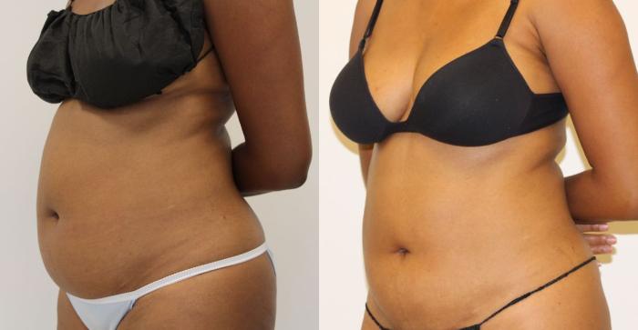 Before & After Liposuction Case 24 View #1 View in Gilbert, AZ