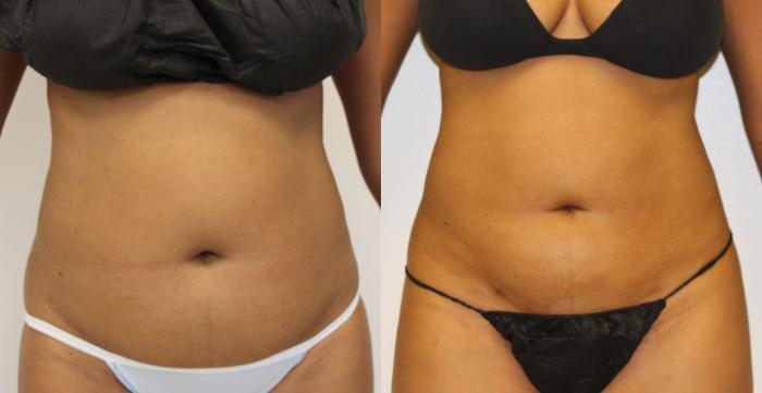 Before & After Liposuction Case 24 View #2 View in Gilbert, AZ