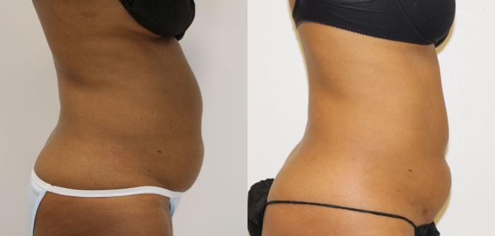 Before & After Liposuction Case 24 View #3 View in Gilbert, AZ