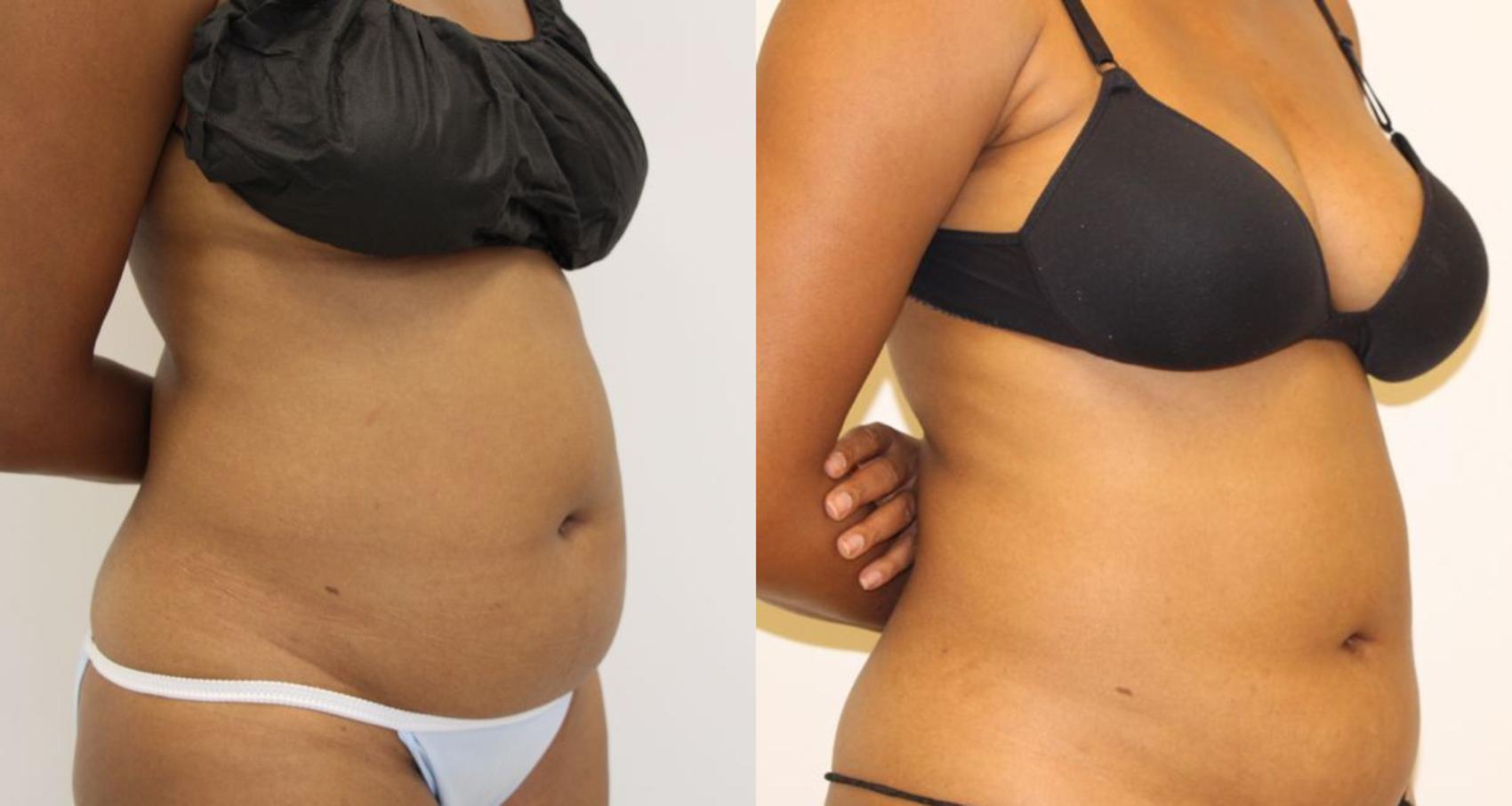 Before & After Liposuction Case 24 View #4 View in Gilbert, AZ