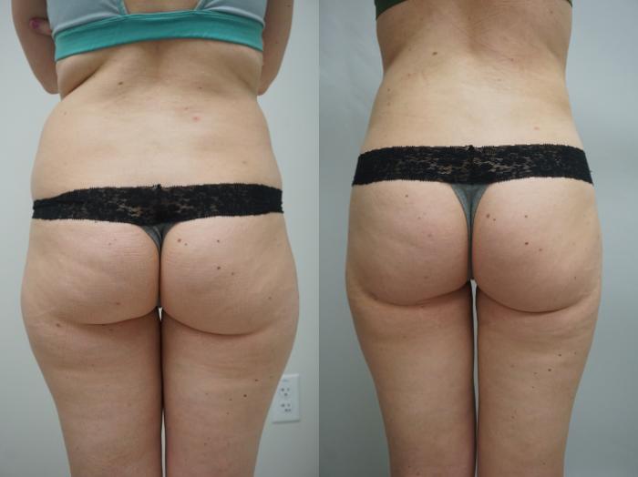 Before & After Liposuction Case 266 View #1 View in Gilbert, AZ