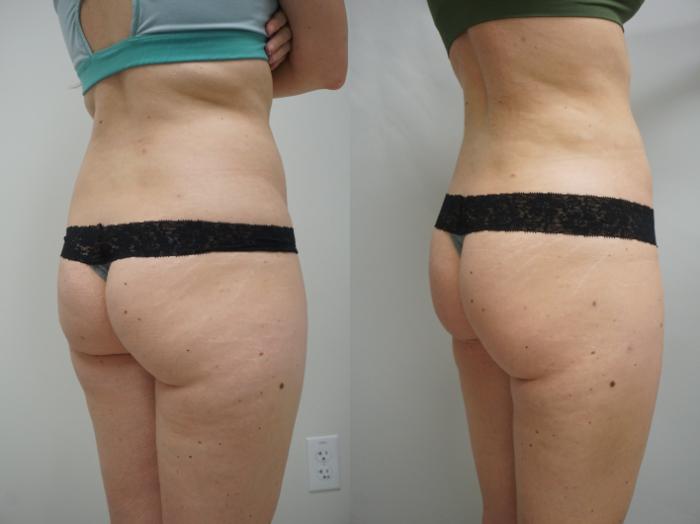 Before & After Liposuction Case 266 View #2 View in Gilbert, AZ