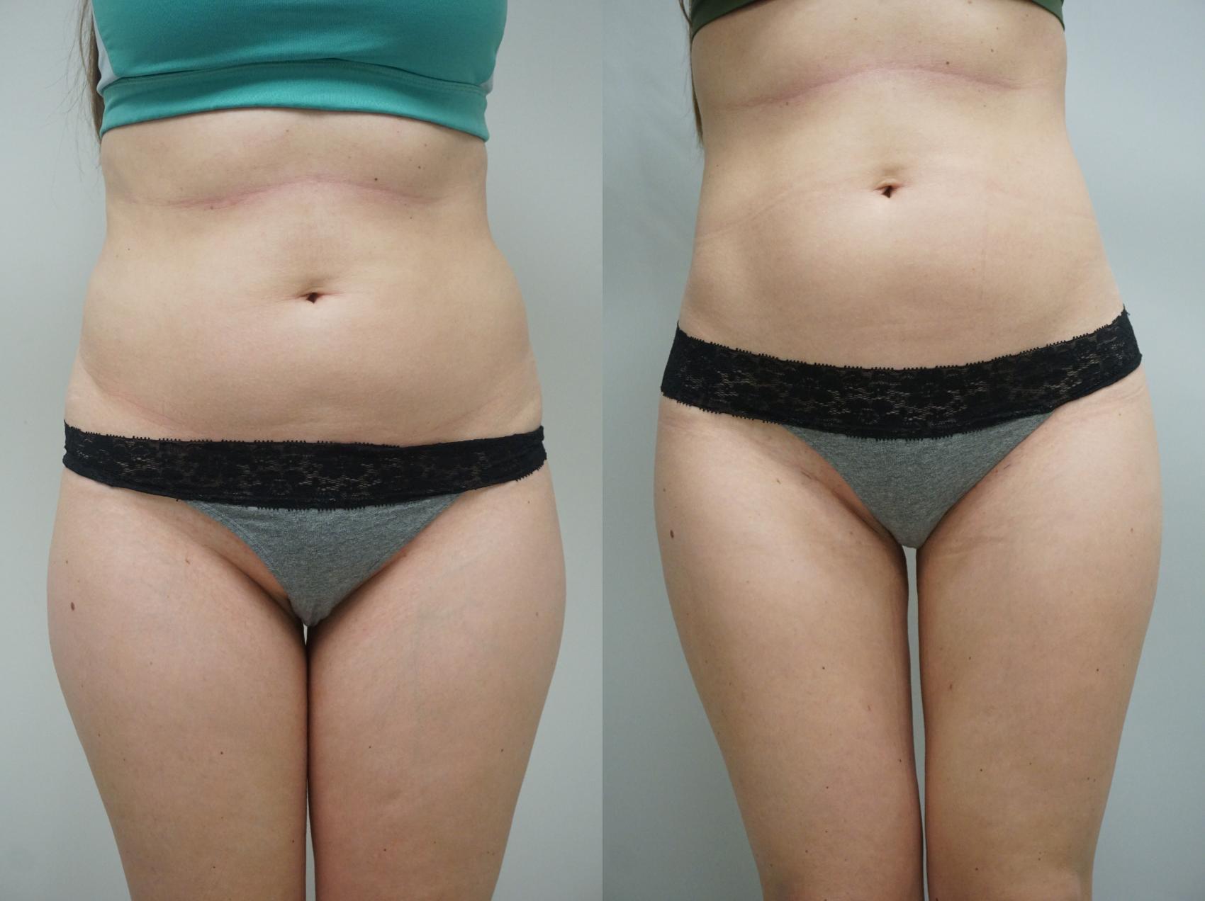 Before & After Liposuction Case 266 View #3 View in Gilbert, AZ