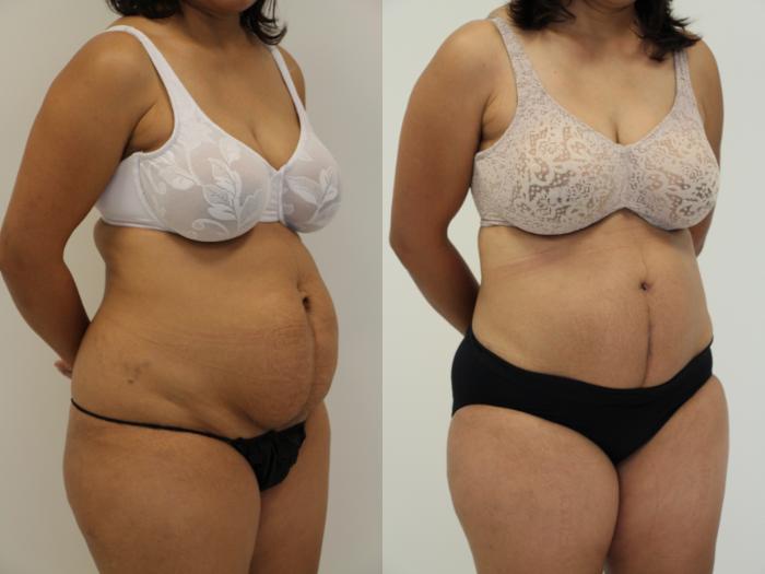 Before & After Liposuction Case 38 View #1 View in Gilbert, AZ