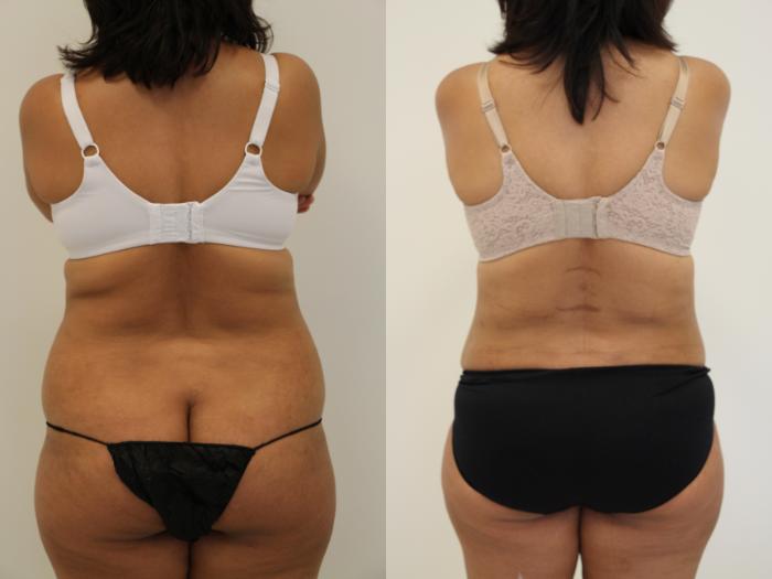 Before & After Liposuction Case 38 View #2 View in Gilbert, AZ