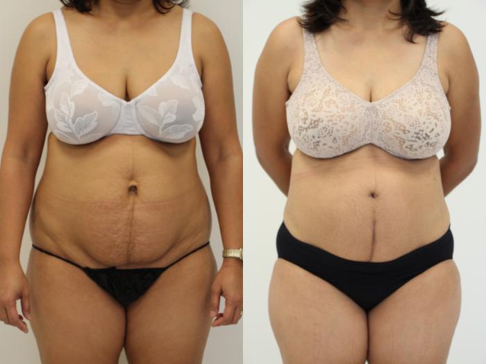 Before & After Liposuction Case 38 View #3 View in Gilbert, AZ