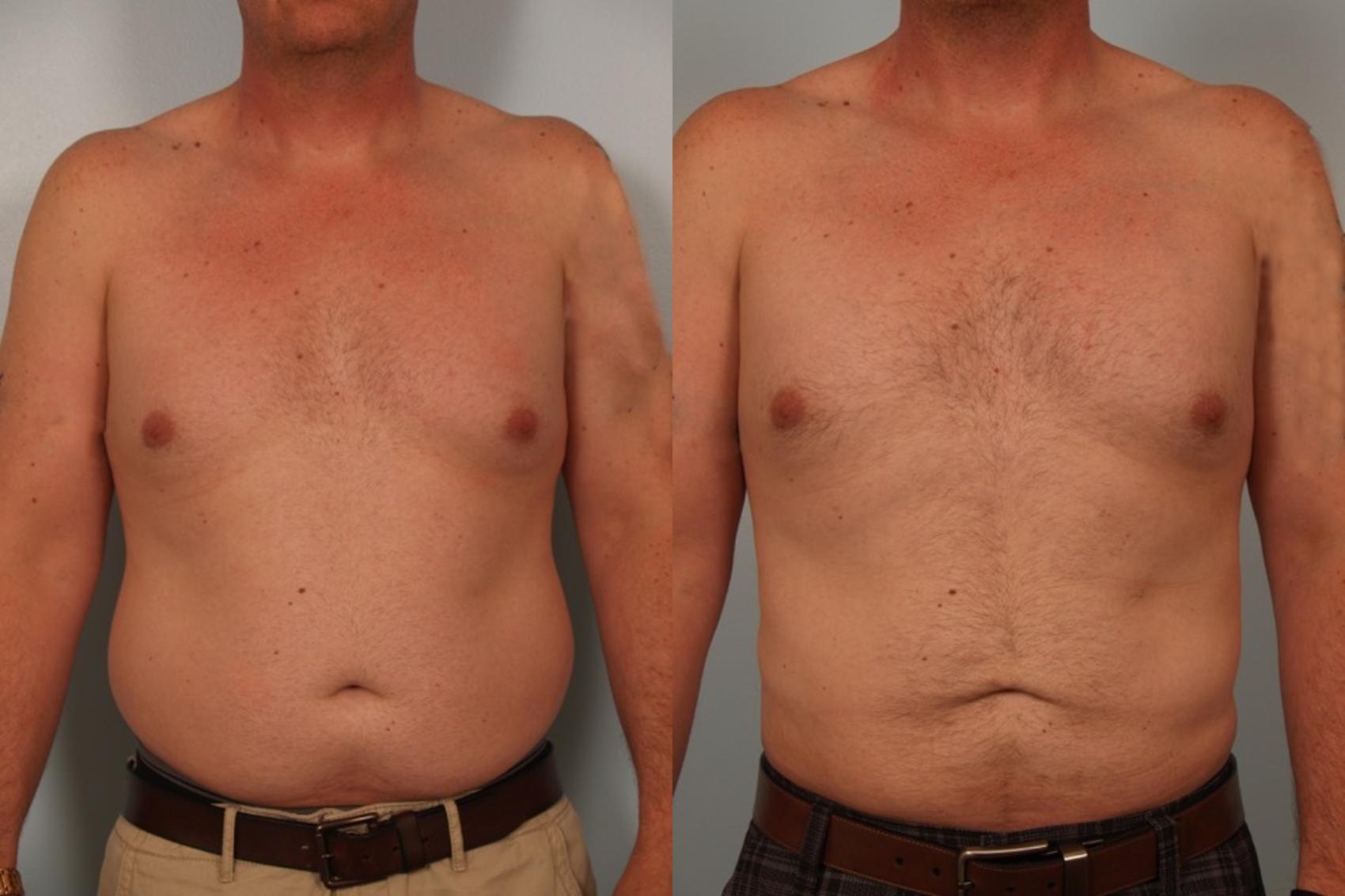 Before & After Liposuction Case 79 View #1 View in Gilbert, AZ