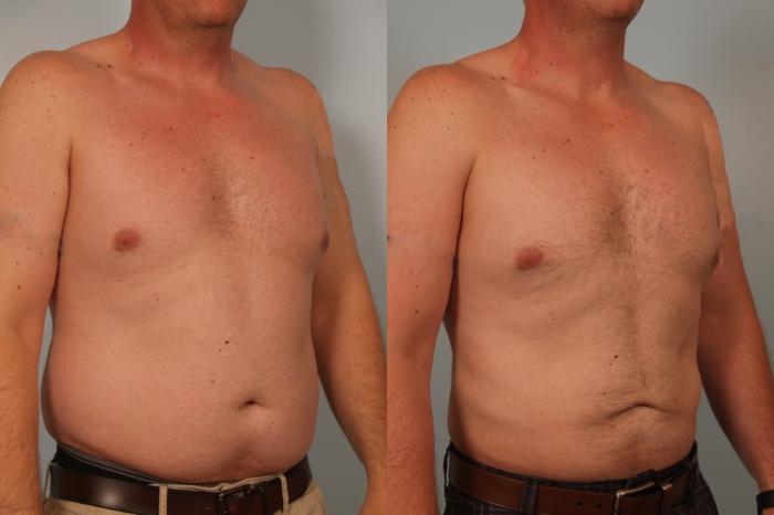 Before & After Liposuction Case 79 View #2 View in Gilbert, AZ