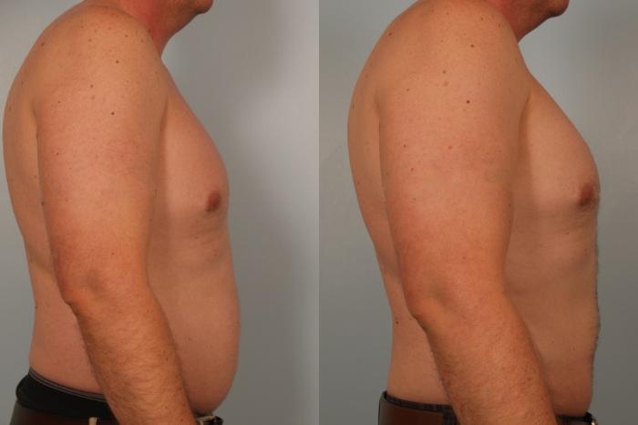 Before & After Liposuction Case 79 View #3 View in Gilbert, AZ