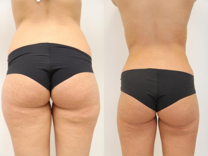 Before & After Liposuction Case 81 View #1 View in Gilbert, AZ