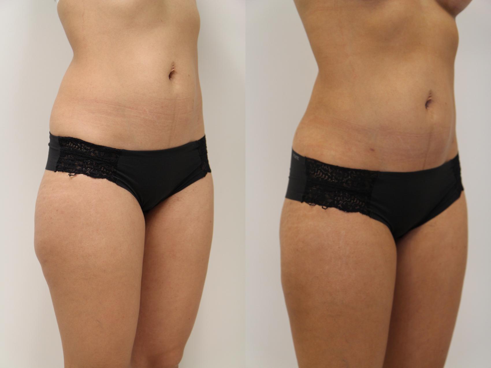Before & After Liposuction Case 81 View #2 View in Gilbert, AZ
