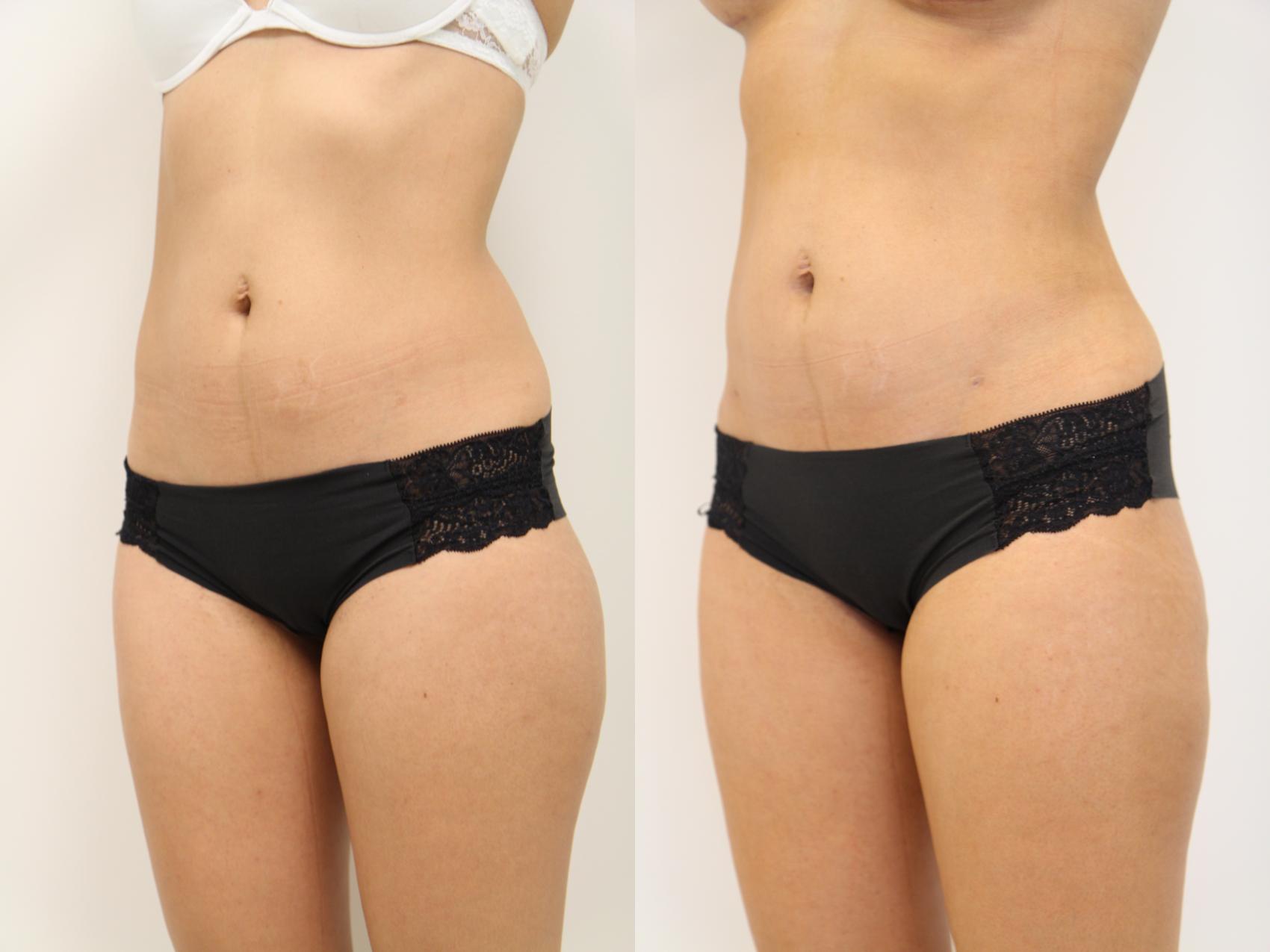Before & After Liposuction Case 81 View #3 View in Gilbert, AZ