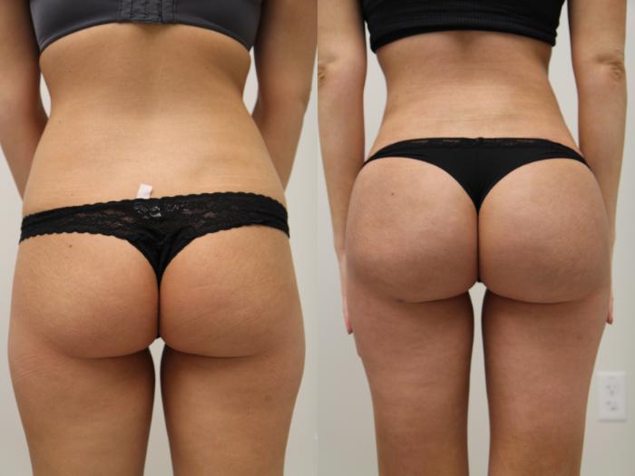 Before & After Liposuction Case 87 View #1 View in Gilbert, AZ