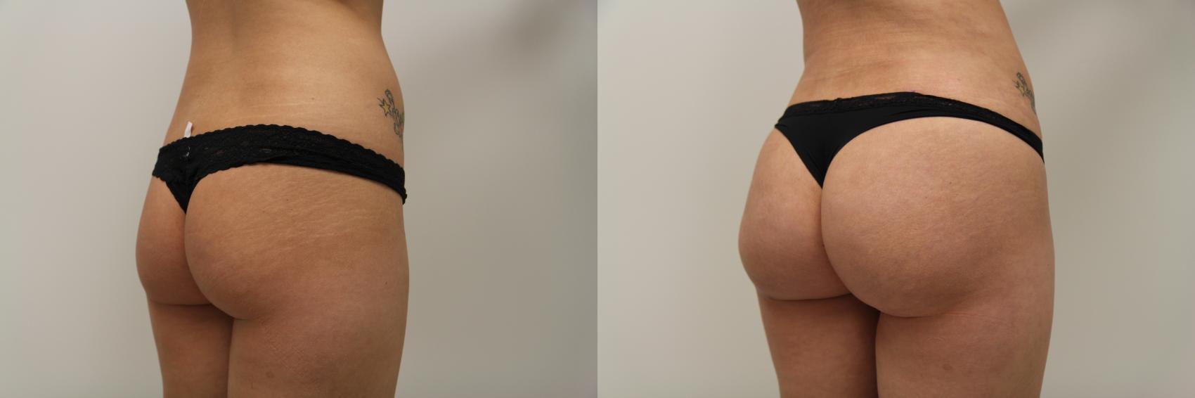 Before & After Brazilian Buttock Lift Case 87 View #2 View in Gilbert, AZ