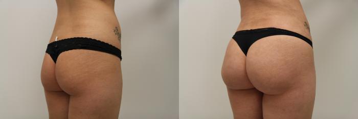 Before & After Liposuction Case 87 View #2 View in Gilbert, AZ