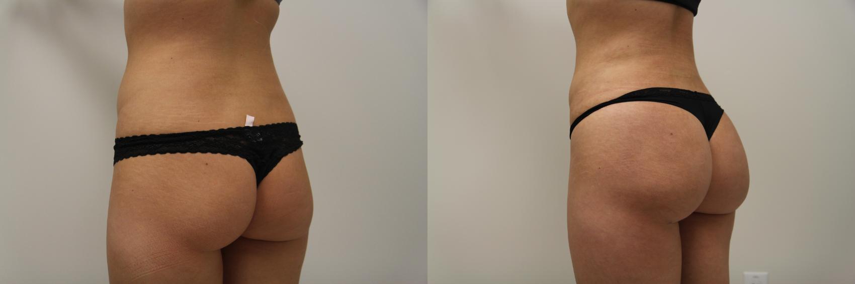 Before & After Liposuction Case 87 View #3 View in Gilbert, AZ