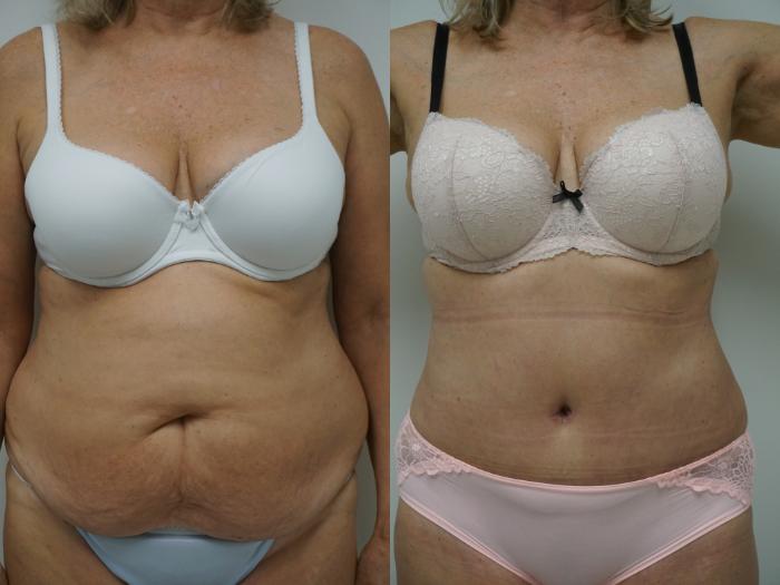 Before & After Liposuction Case 99 View #1 View in Gilbert, AZ