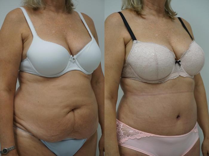Before & After Liposuction Case 99 View #2 View in Gilbert, AZ