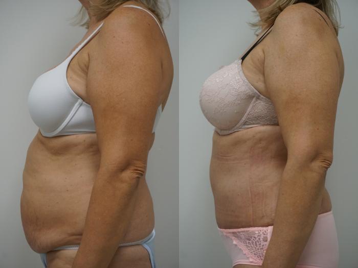Before & After Liposuction Case 99 View #3 View in Gilbert, AZ