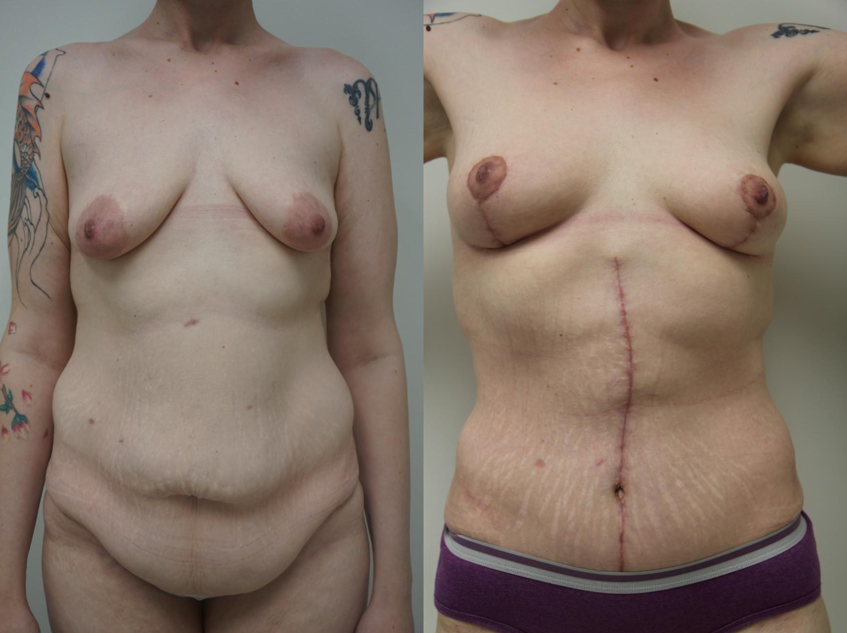 Before & After Mommy Makeover Case 108 View #2 View in Gilbert, AZ