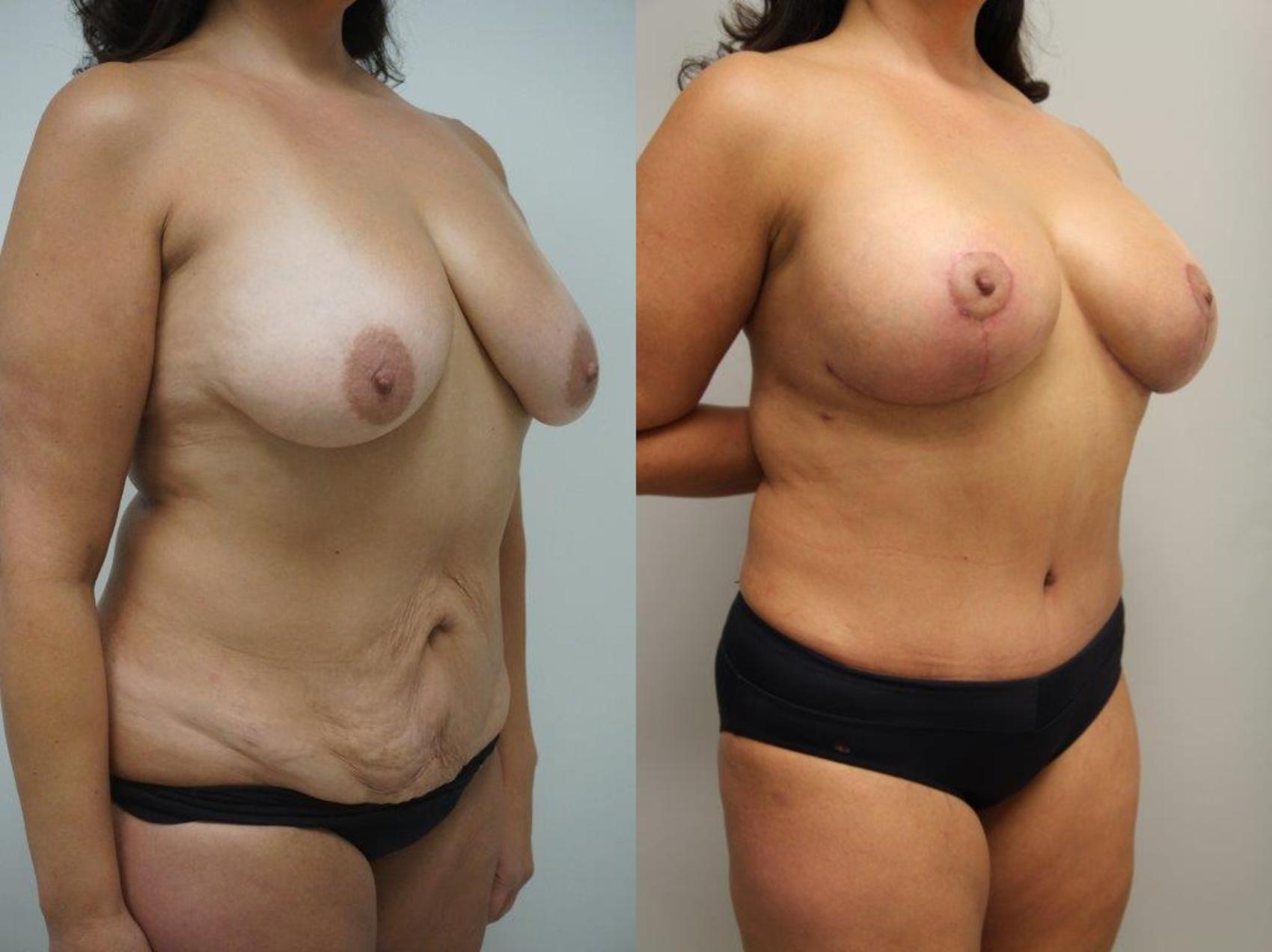 Before & After Mommy Makeover Case 122 View #2 View in Gilbert, AZ