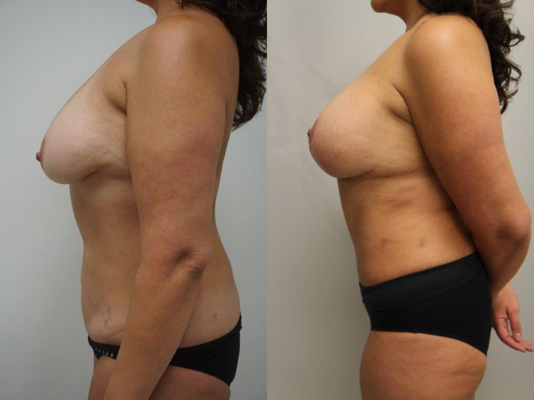 Before & After Mommy Makeover Case 122 View #3 View in Gilbert, AZ