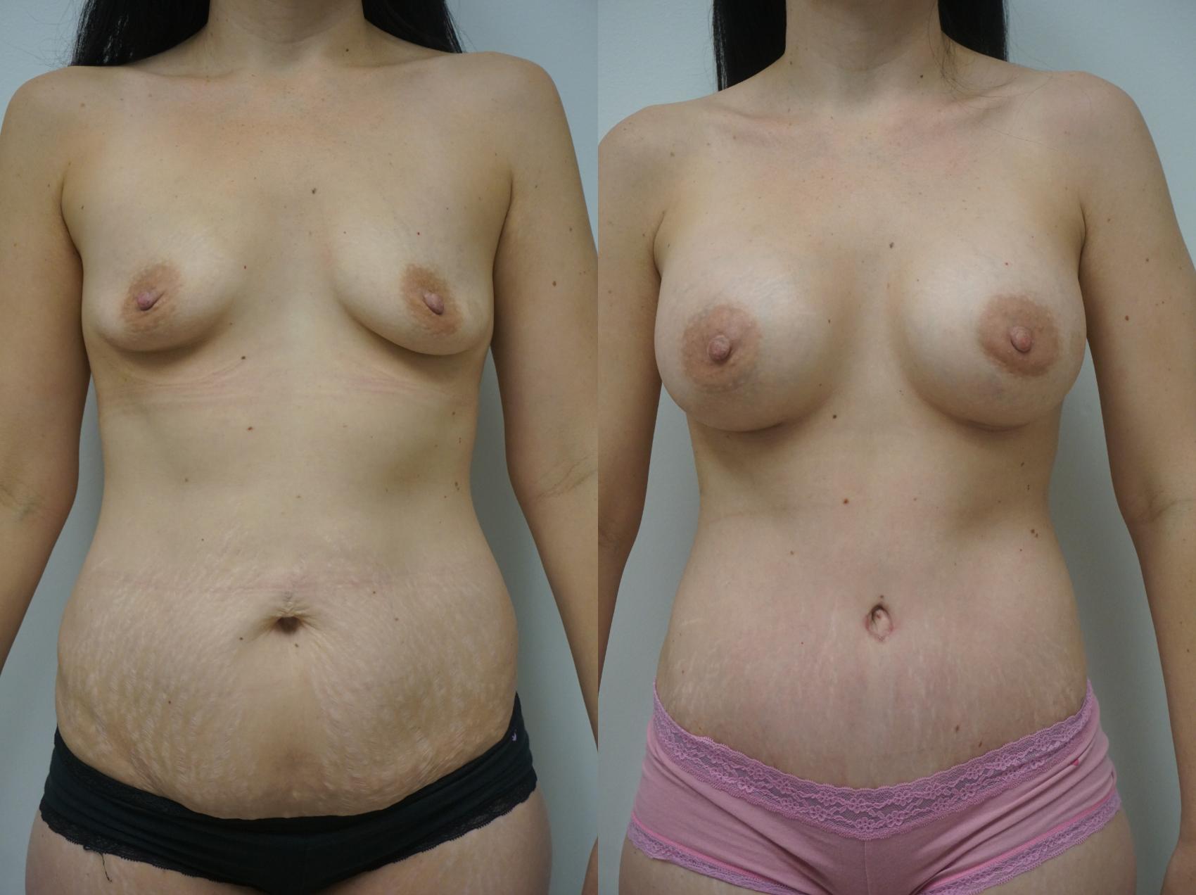 Before & After Mommy Makeover Case 132 View #2 View in Gilbert, AZ