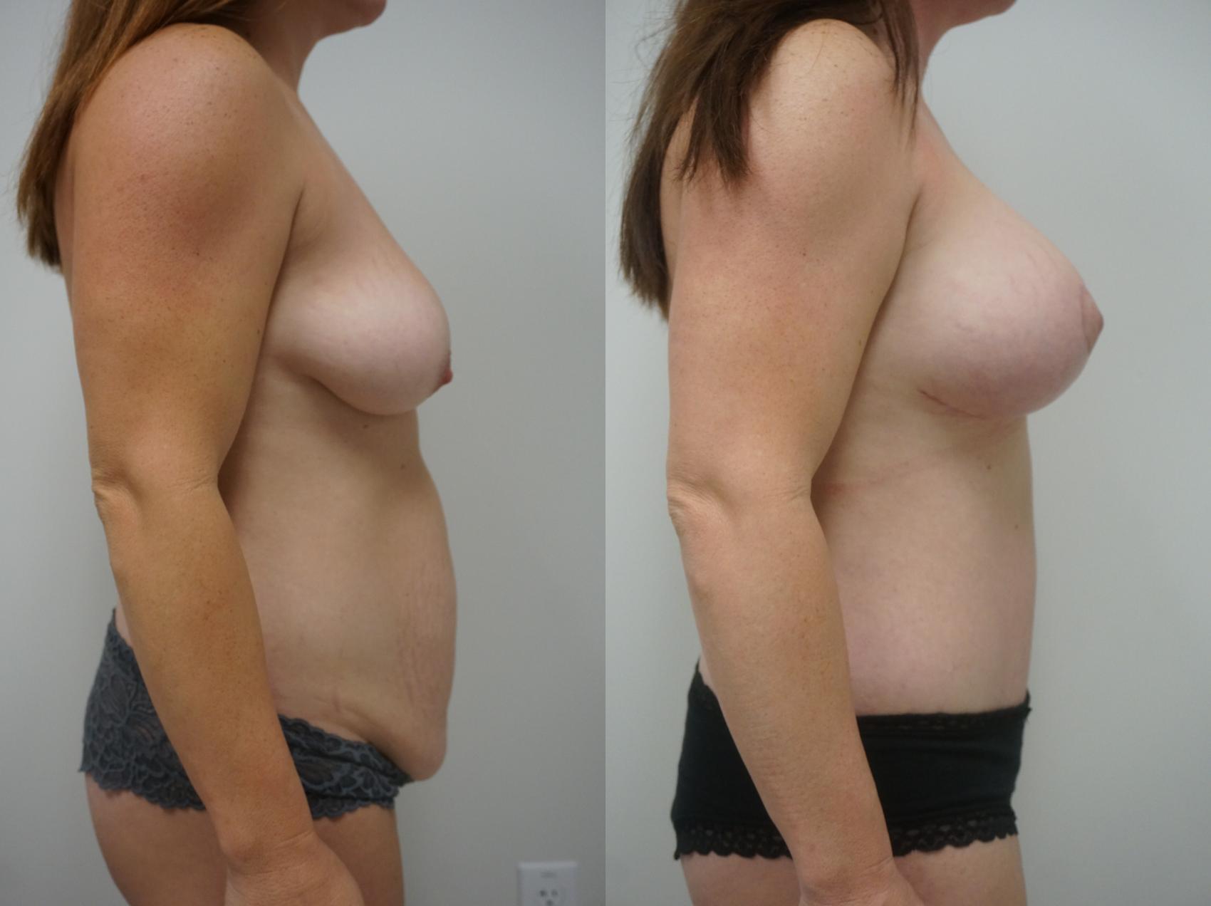 Before & After Mommy Makeover Case 155 View #3 View in Gilbert, AZ