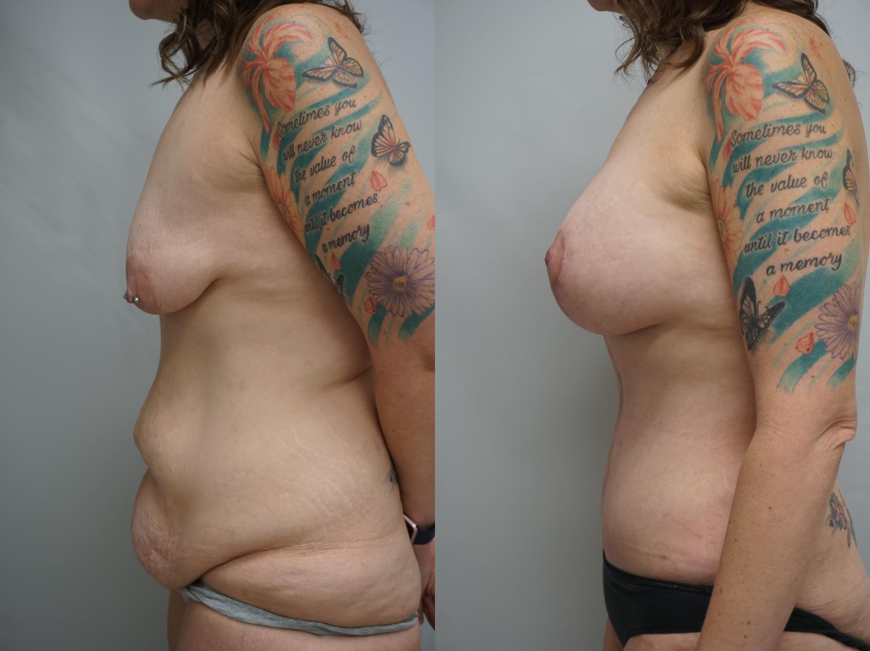 Before & After Mommy Makeover Case 199 View #2 View in Gilbert, AZ