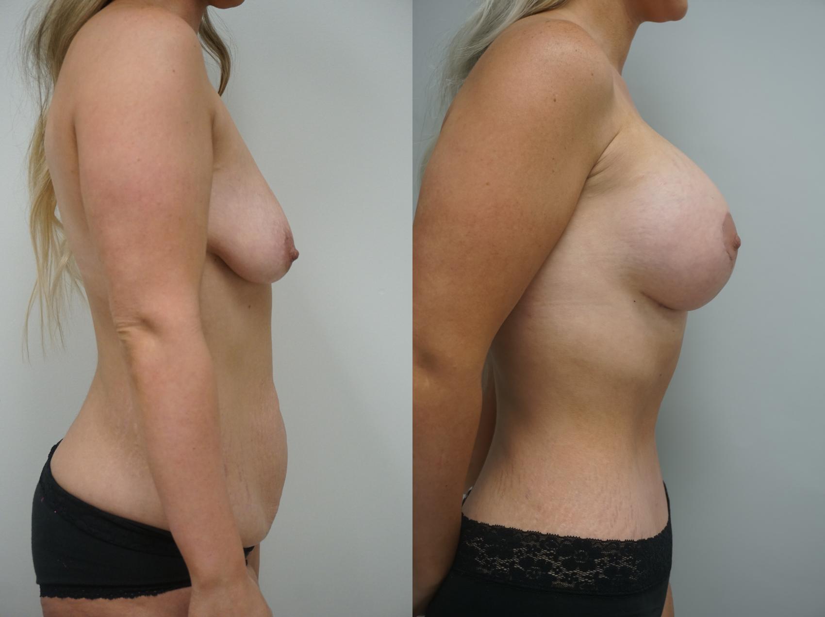 Before & After Mommy Makeover Case 209 View #2 View in Gilbert, AZ