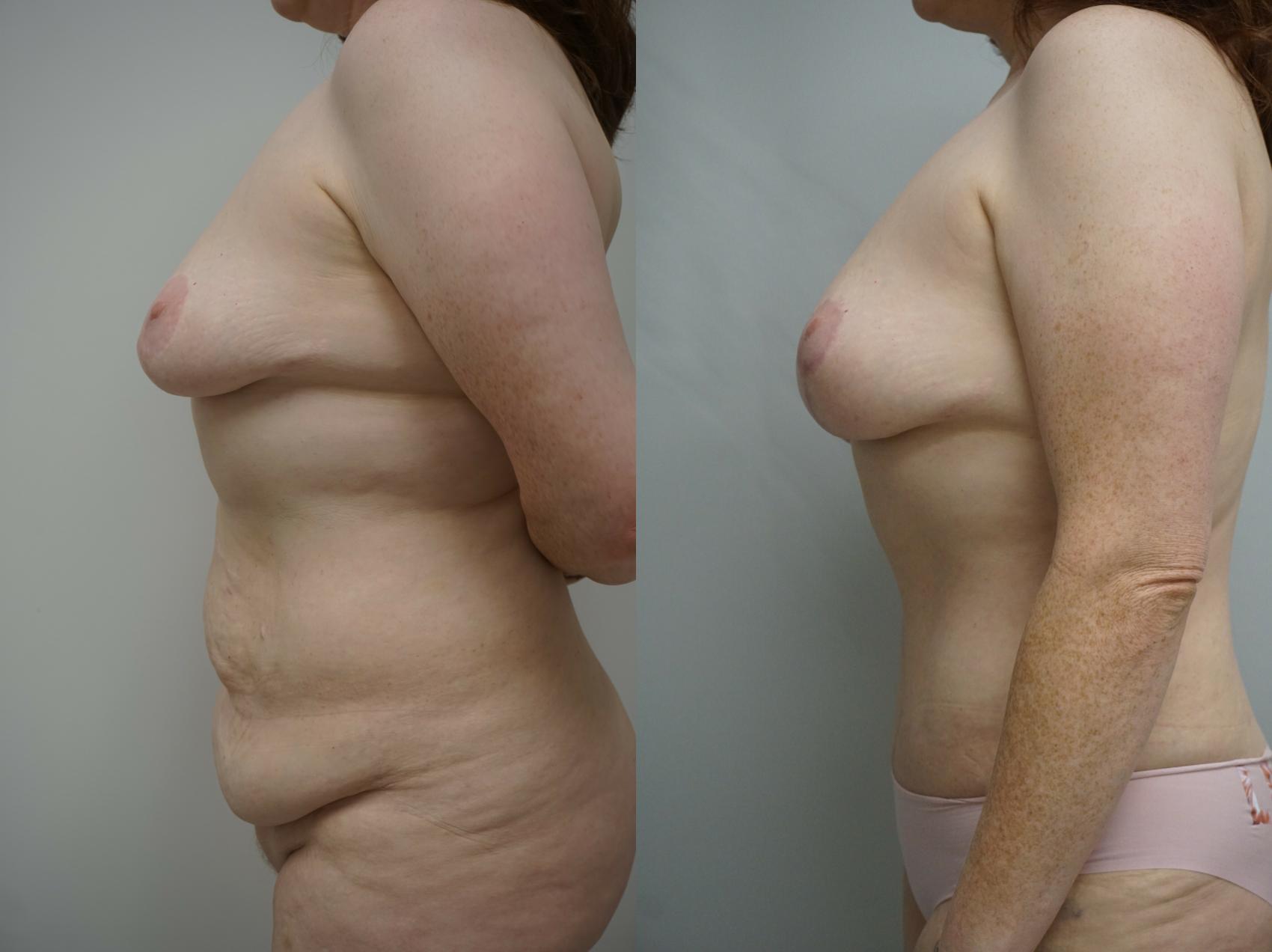 Before & After Mommy Makeover Case 226 View #2 View in Gilbert, AZ