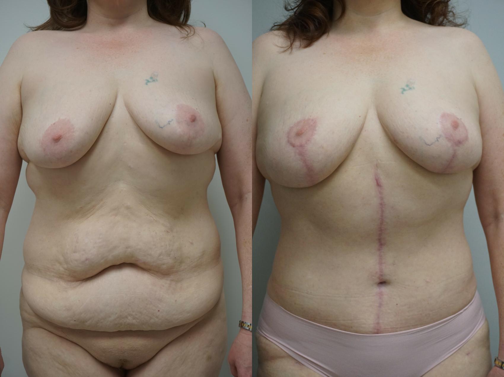 Before & After Mommy Makeover Case 226 View #3 View in Gilbert, AZ