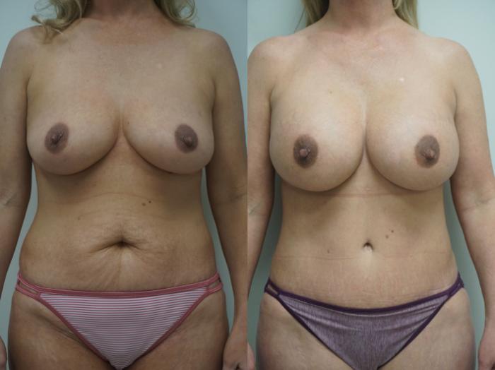 Before & After Breast Augmentation Case 323 Front View in Gilbert, AZ