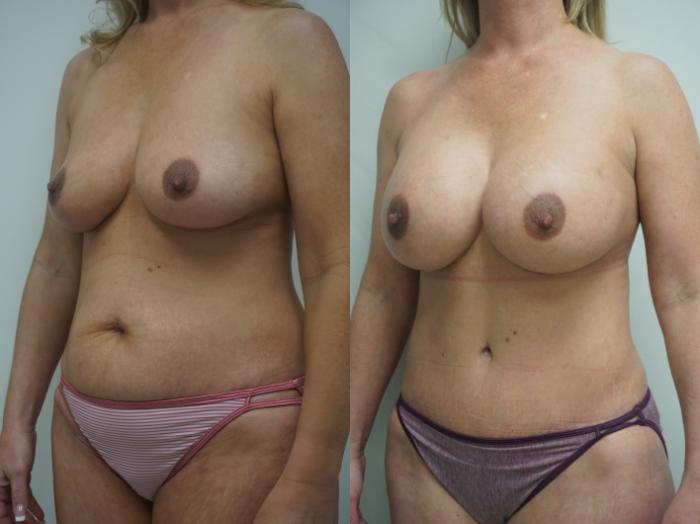Before & After Breast Augmentation Case 323 Left Oblique View in Gilbert, AZ