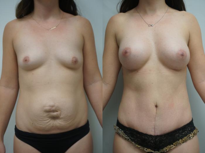 Before & After Tummy Tuck (Abdominoplasty) Case 336 Front View in Gilbert, AZ