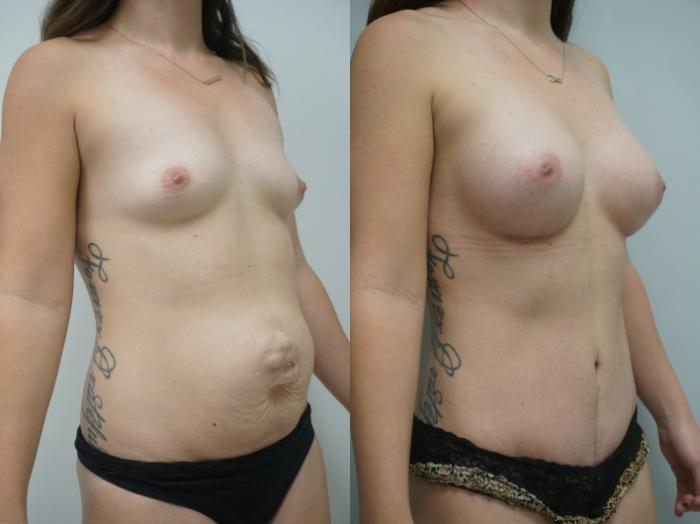 Before & After Tummy Tuck (Abdominoplasty) Case 336 Left Oblique View in Gilbert, AZ