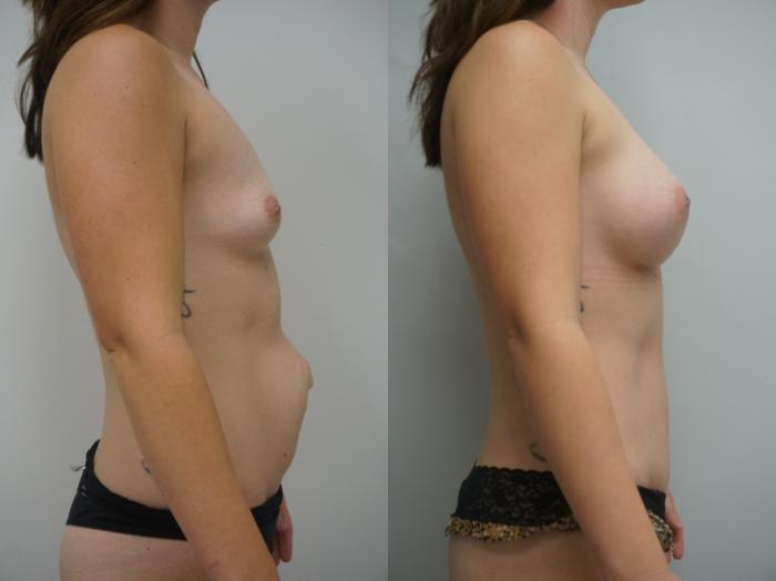 Before & After Tummy Tuck (Abdominoplasty) Case 336 Left Side View in Gilbert, AZ