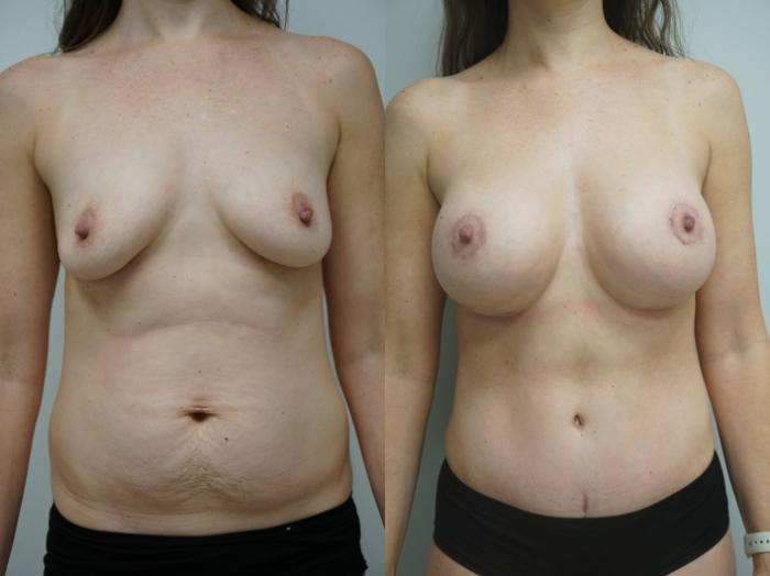 Before & After Breast Augmentation Case 339 Front View in Gilbert, AZ