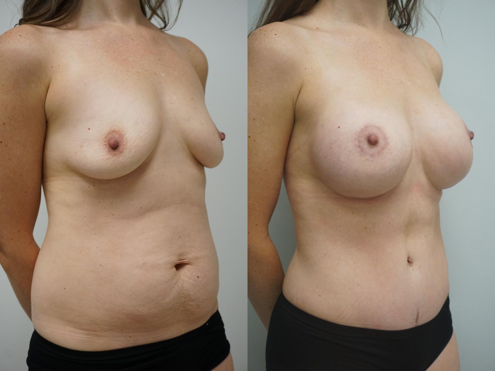 Before & After Tummy Tuck (Abdominoplasty) Case 339 Right Oblique View in Gilbert, AZ