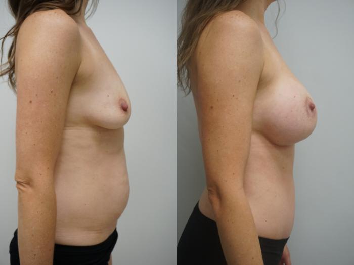 Before & After Breast Augmentation Case 339 Right Side View in Gilbert, AZ