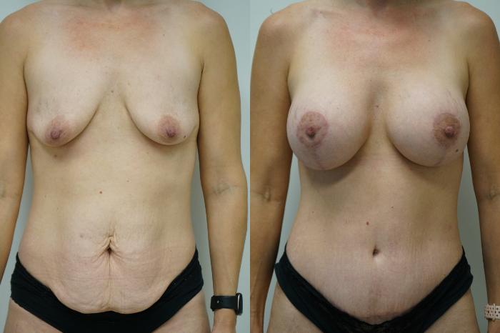 Before & After Breast Augmentation with Breast Lift  Case 399 Front View in Gilbert, AZ