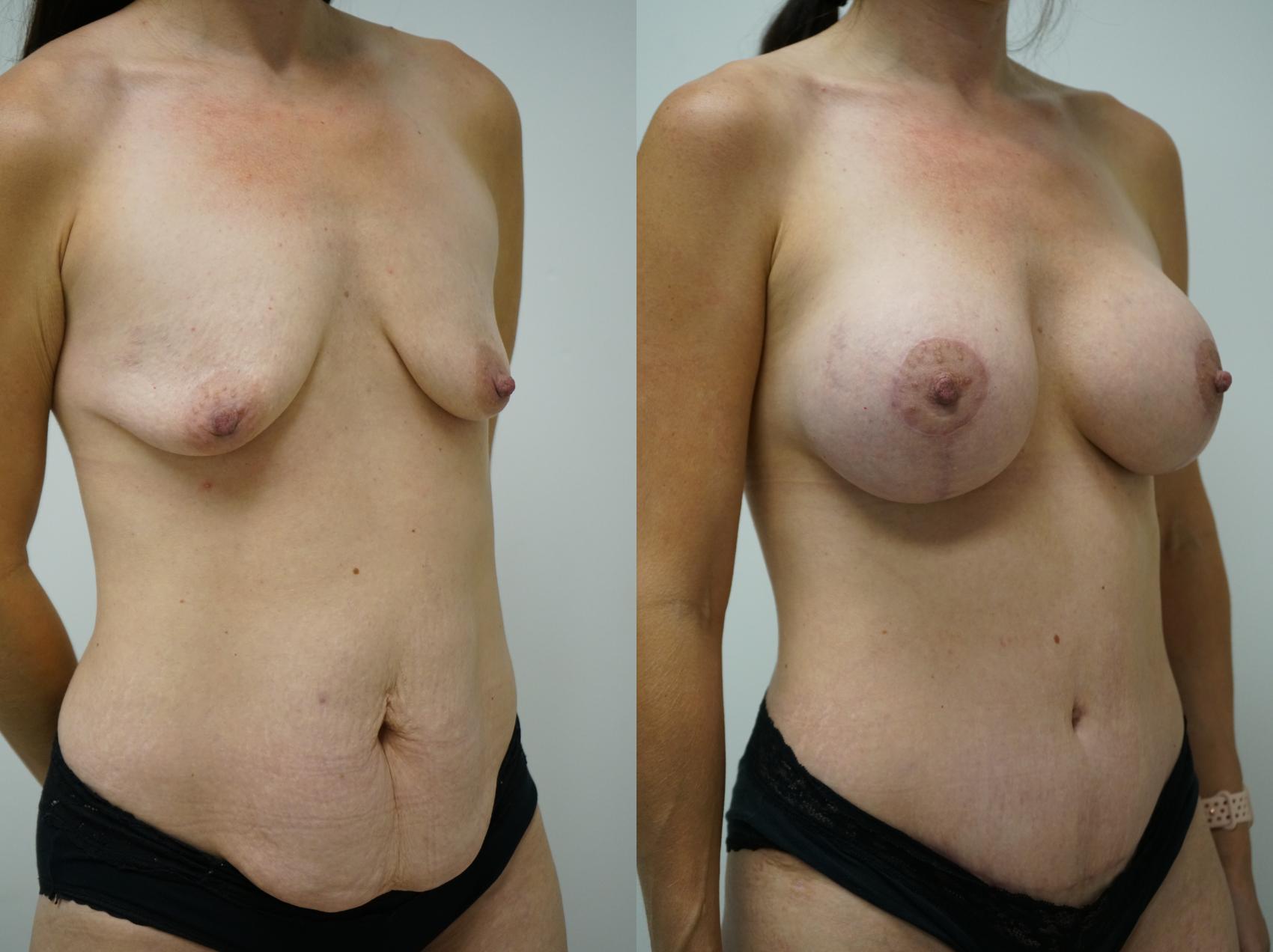 Before & After Breast Augmentation with Breast Lift  Case 399 Right Oblique View in Gilbert, AZ