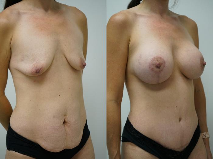 Before & After Mommy Makeover Case 399 Right Oblique View in Gilbert, AZ