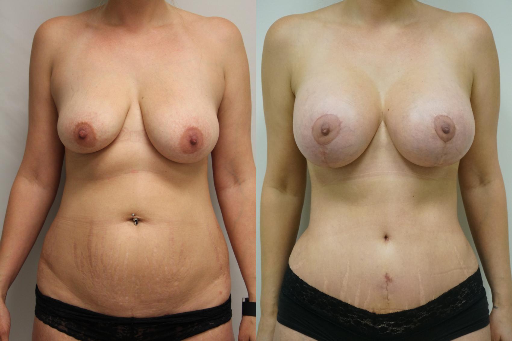 Before & After Mommy Makeover Case 402 Front View in Gilbert, AZ