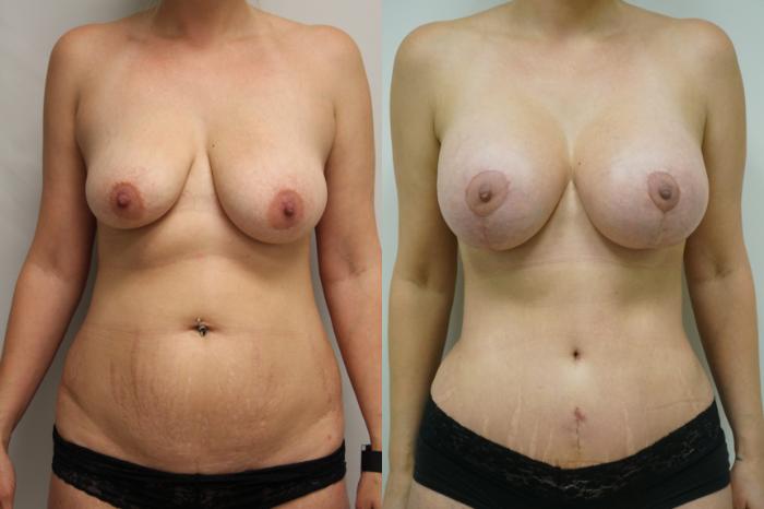 Before & After Breast Augmentation with Breast Lift  Case 402 Front View in Gilbert, AZ