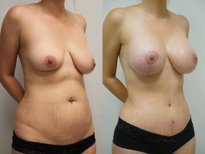 Before & After Tummy Tuck (Abdominoplasty) Case 402 Right Oblique View in Gilbert, AZ